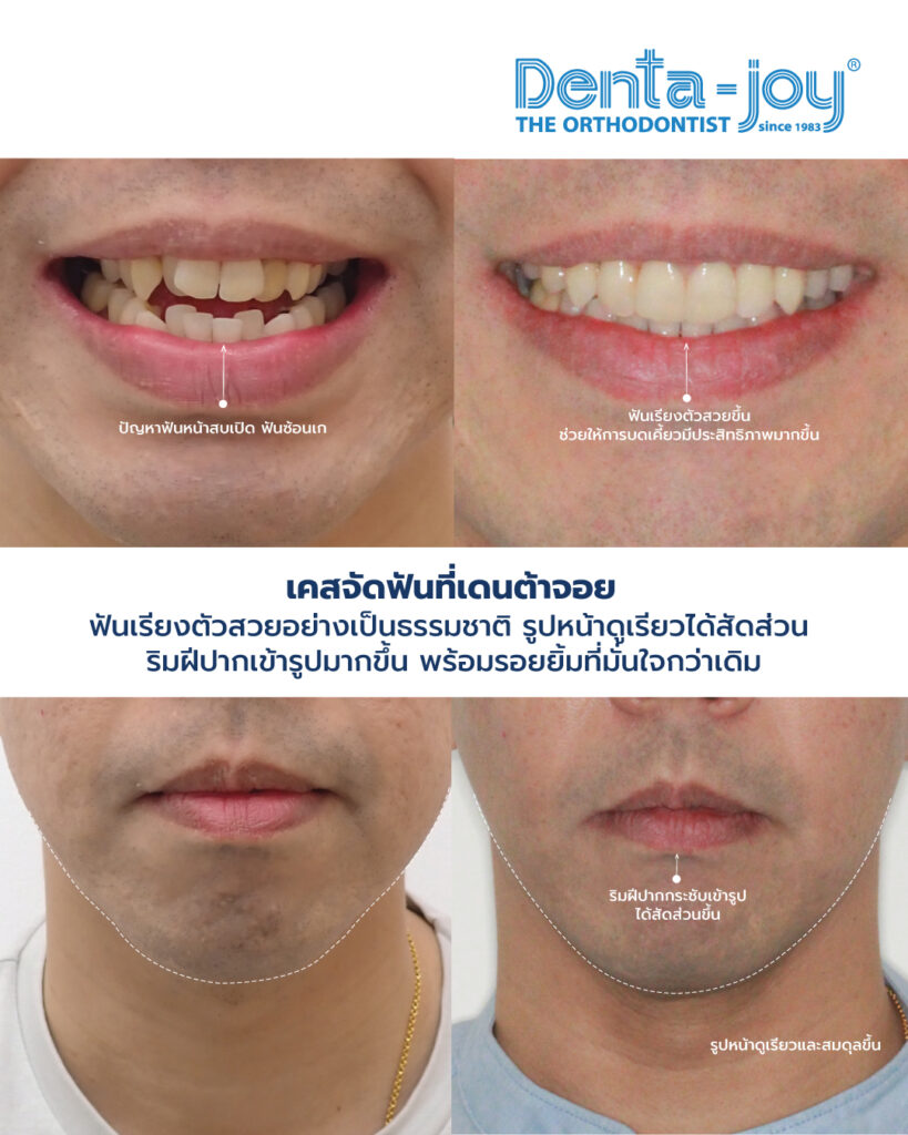 จัดฟันหน้าเรียว