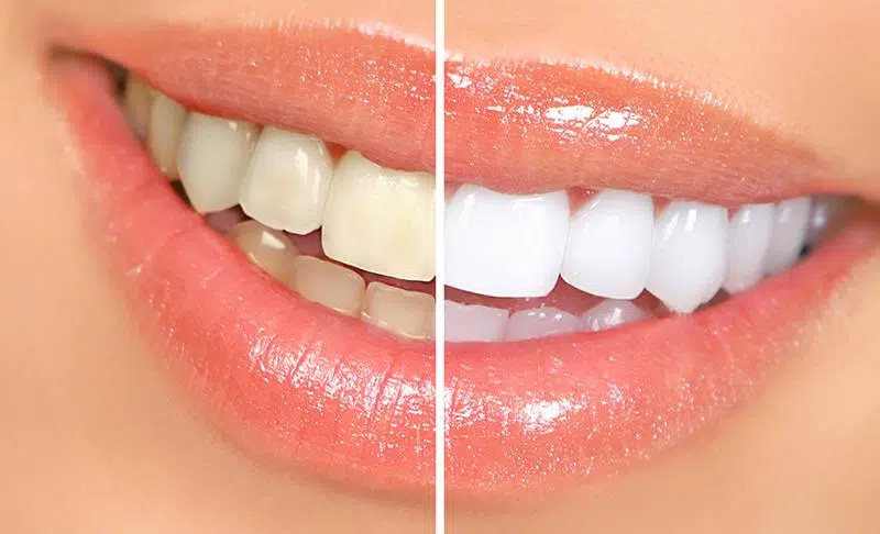 ฟันเหลือง-วีเนียร์-ฟันขาว