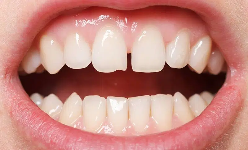 ฟันห่าง-ช่องว่างระหว่างฟัน