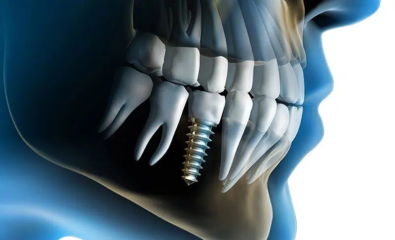 Implant-03