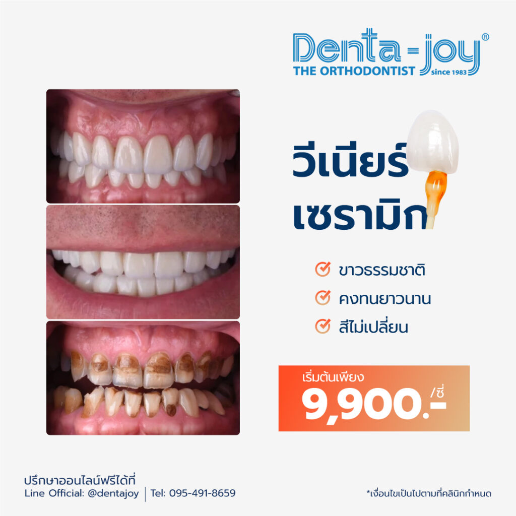 โปรโมชั่นวีเนียร์ veneer ราคา