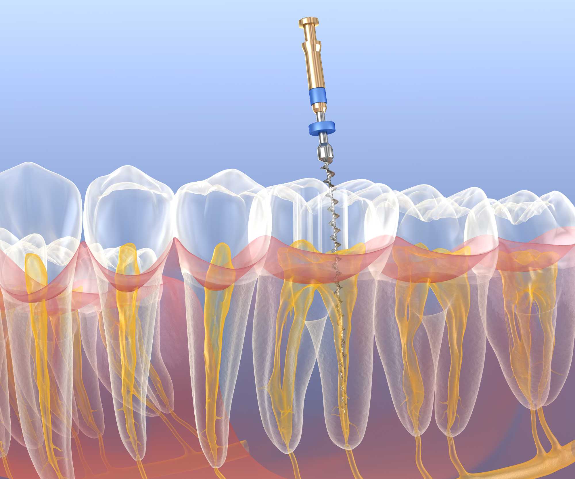 รักษารากฟัน_endodontics