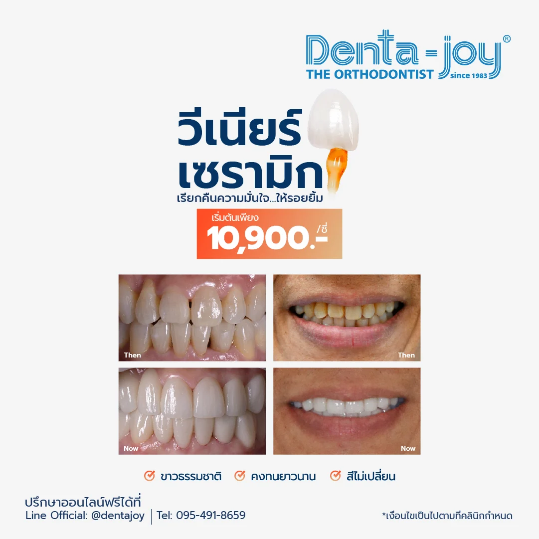 promotion veneers at Dentajoy dental clinic ,Bangkok , Thailand