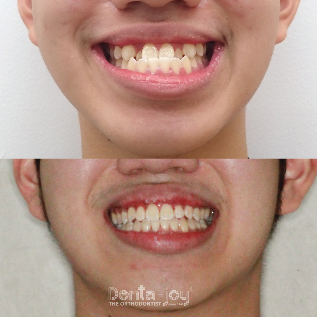 เคสจัดฟันใสแก้ไขคางยื่น ฟันล่างคร่อมบน ด้วย Invisalign ไม่ผ่าตัด Orthodontics treatment using Invisalign with non-surgery approach to correct anterior crossbite and protruding chin