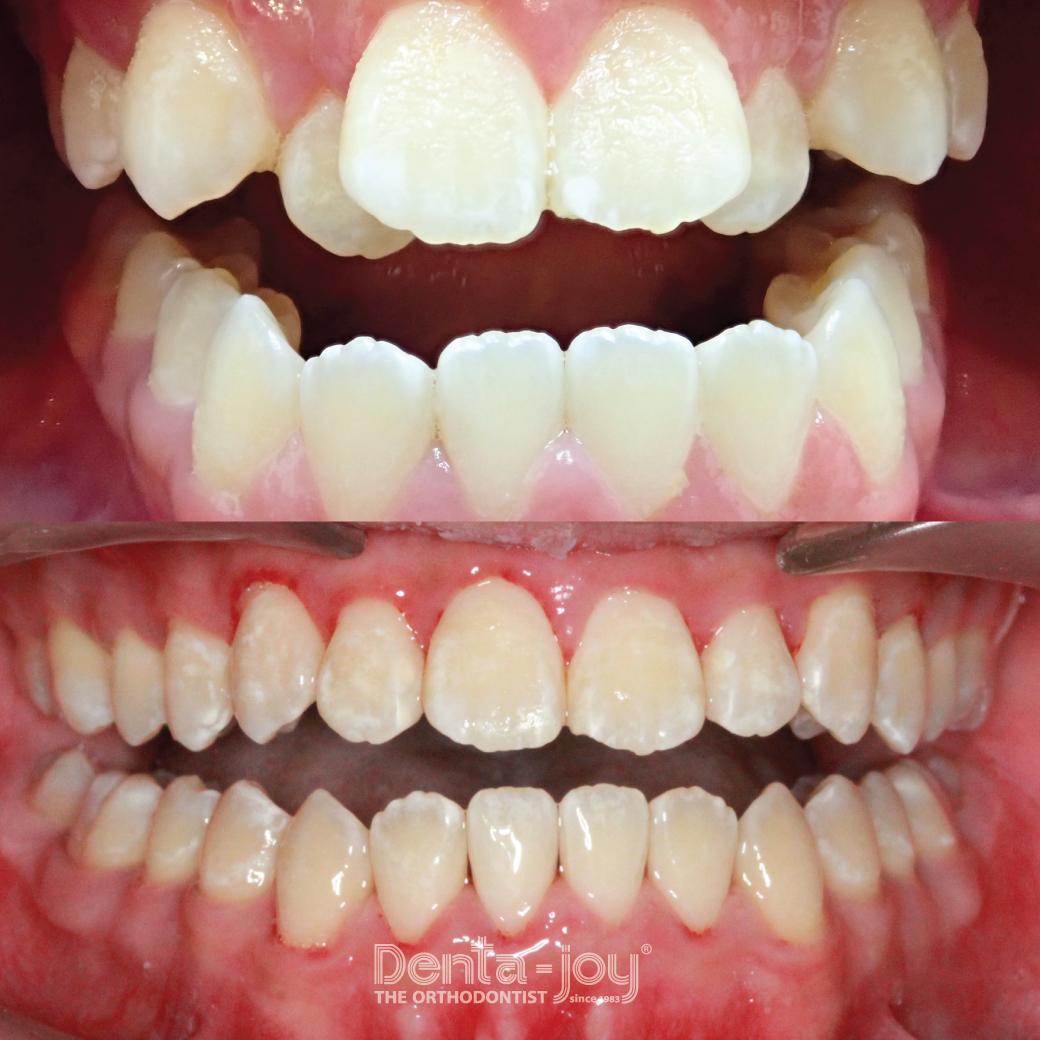 เคสรีวิวจัดฟันแบบใส Invisalign ลักษณะฟันซ้อนเกมากโดยเฉพาะฟันหน้าบน Orthodontics treatment using Invisalign to solve severe anterior crooked and crowding teeth