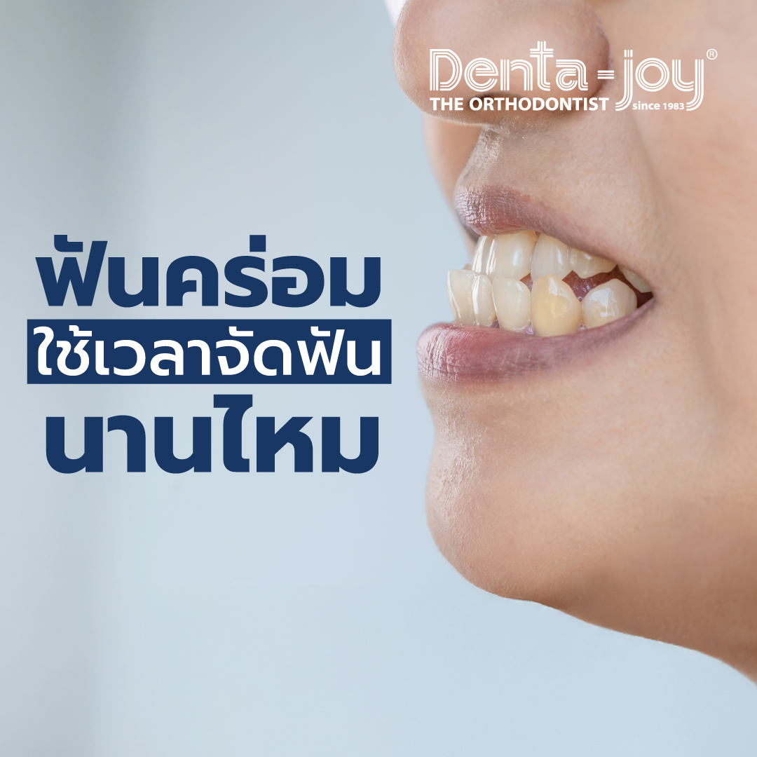 ฟันคร่อมจัดฟันนานไหม