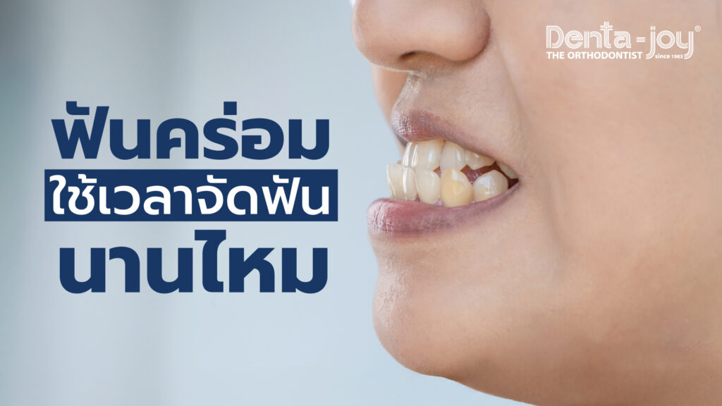 ฟันล่างคร่อมฟันบน สาเหตุ ผลกระทบ วิธีการรักษา จัดฟันนานไหม