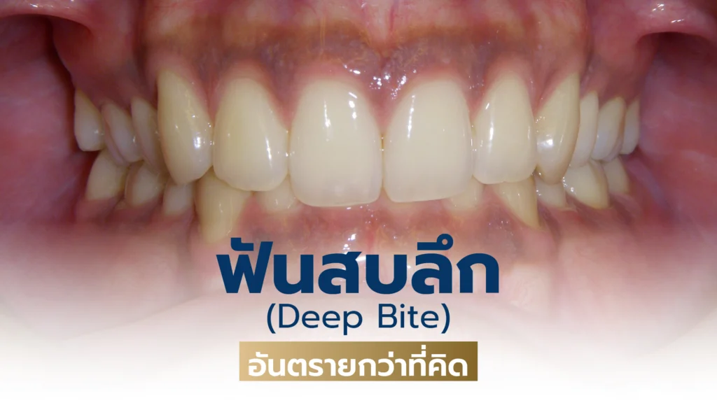 ฟันสบลึก Deep Bite อันตรายกว่าที่คิด 