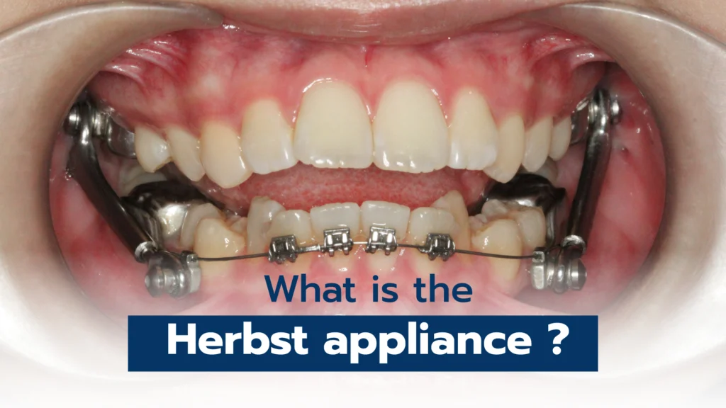 What is the Herbst appliance?