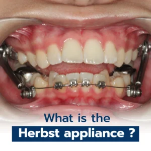 What is the Herbst appliance?