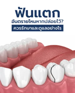 ฟันแตก อันตรายไหมหากปล่อยไว้? ควรรักษาและดูแลอย่างไร