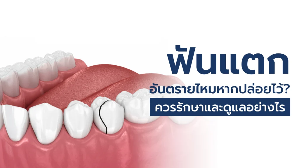 ฟันแตก ฟันบิ่น และรอยร้าวในฟัน 