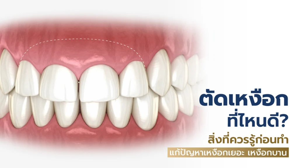 ตัดเหงือก (Gummy Smile) ที่ไหนดี? สิ่งที่ควรรู้ก่อนทำ แก้ปัญหาเหงือกเยอะ เหงือกบาน